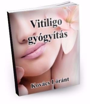 A vitiligo ma már kezelhető! Létező megoldások vitiligora! - kép 2