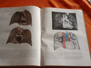 Les Fondements Anatomo-radiologiques de L'Investigation Pulmonaire (A tüdő anatómiai vizsgálata - fr - kép 9