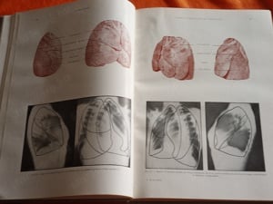 Les Fondements Anatomo-radiologiques de L'Investigation Pulmonaire (A tüdő anatómiai vizsgálata - fr - kép 5