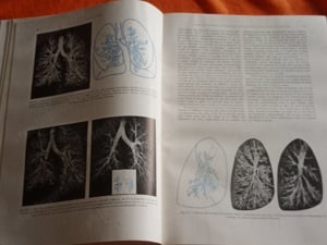 Les Fondements Anatomo-radiologiques de L'Investigation Pulmonaire (A tüdő anatómiai vizsgálata - fr - kép 6